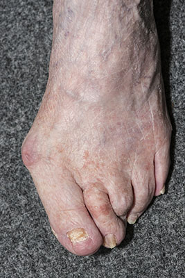 bunion 2