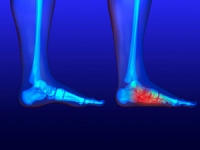 The Link Between Foot Pressure and Flat Feet