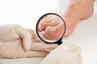 What Are the Risk Factors for Fungal Nail Development?