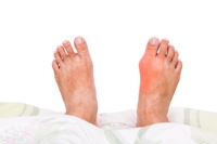 How Does Gout Occur?