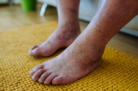 Avoiding Diabetic Foot Ulcers